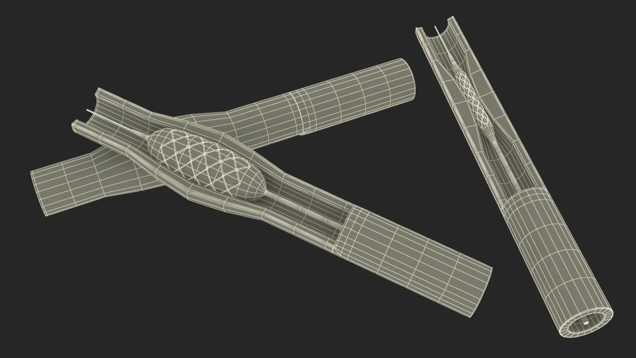 3D model Stents with Artery 2