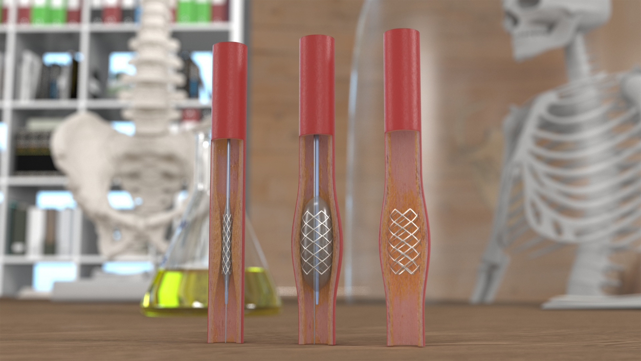 3D model Stents with Artery 2