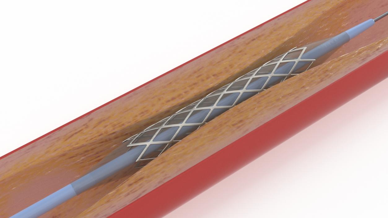 3D model Stents with Artery 2