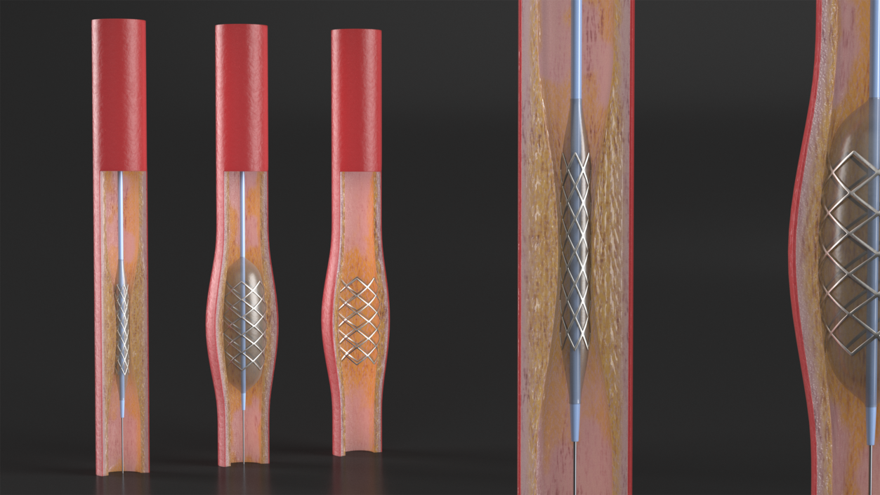 3D model Stents with Artery 2