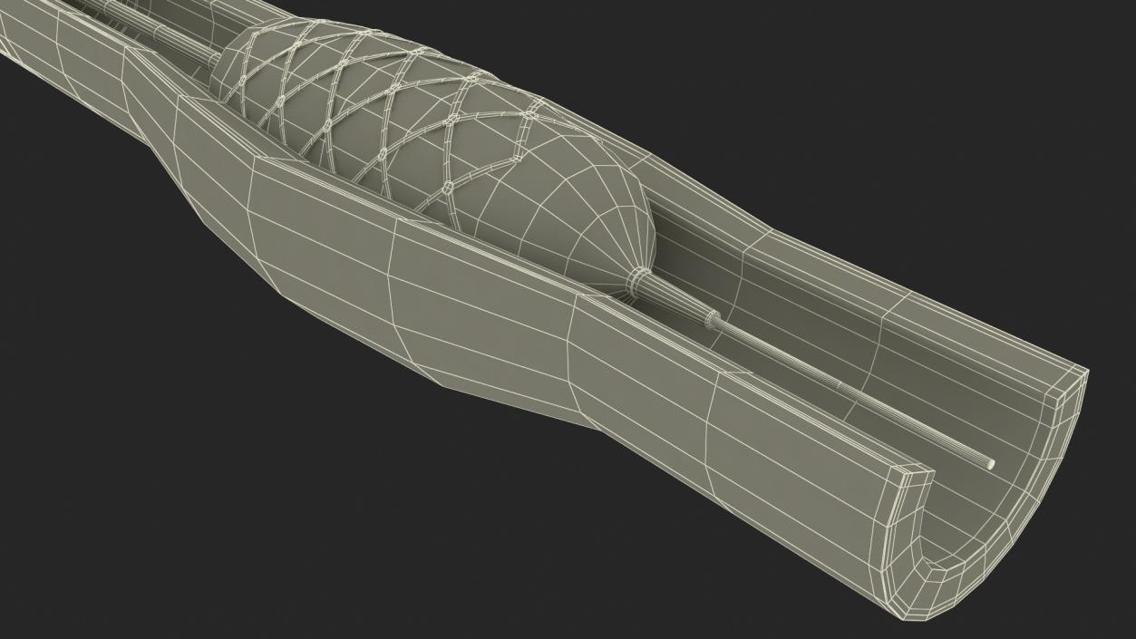 3D model Stents with Artery 2