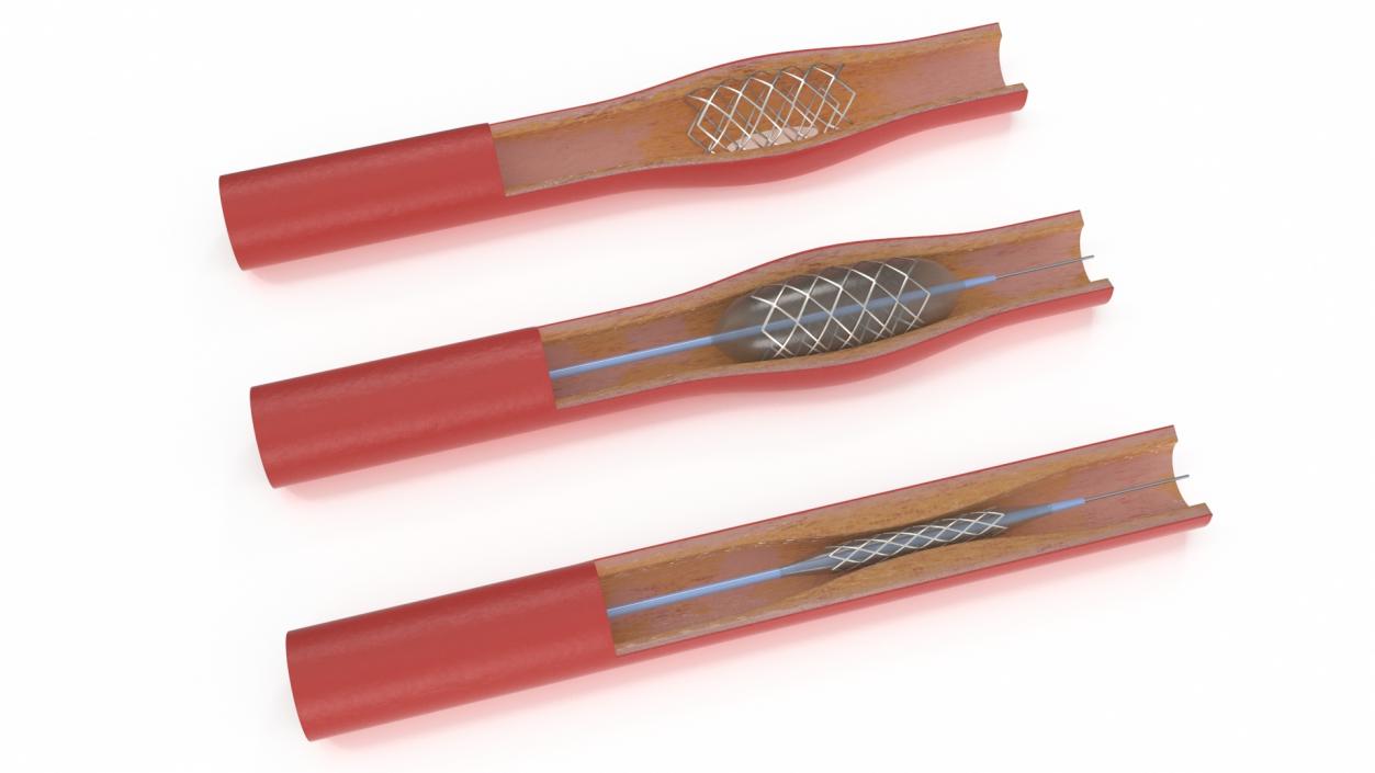 3D model Stents with Artery 2