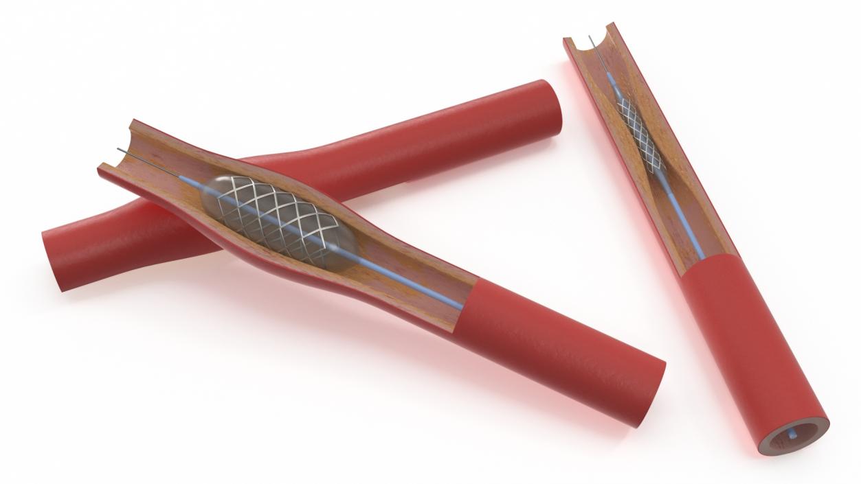 3D model Stents with Artery 2