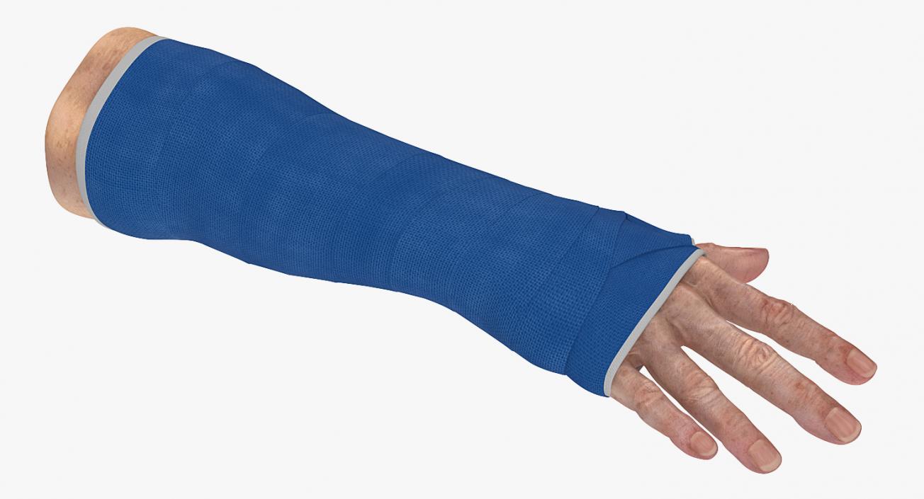 3D Fiberglass Cast Wrist