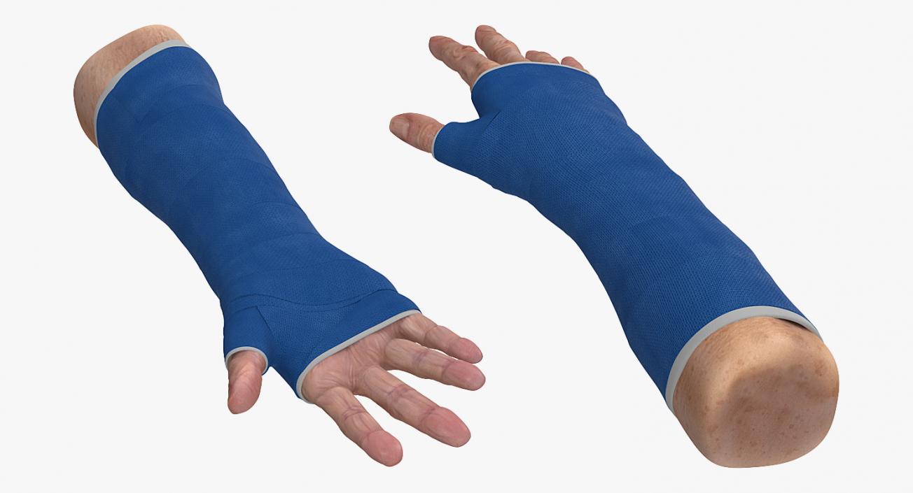 3D Fiberglass Cast Wrist