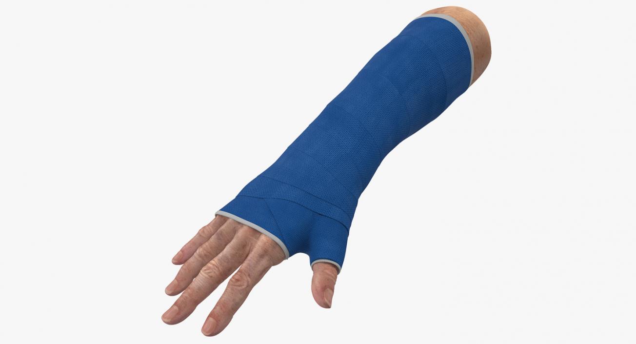 3D Fiberglass Cast Wrist