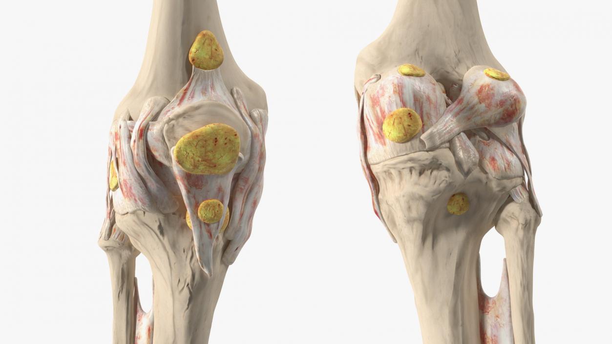 3D Human Knee Bones