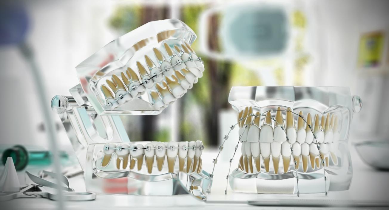 3D Dental Tooth Braces and Retainer Collection model