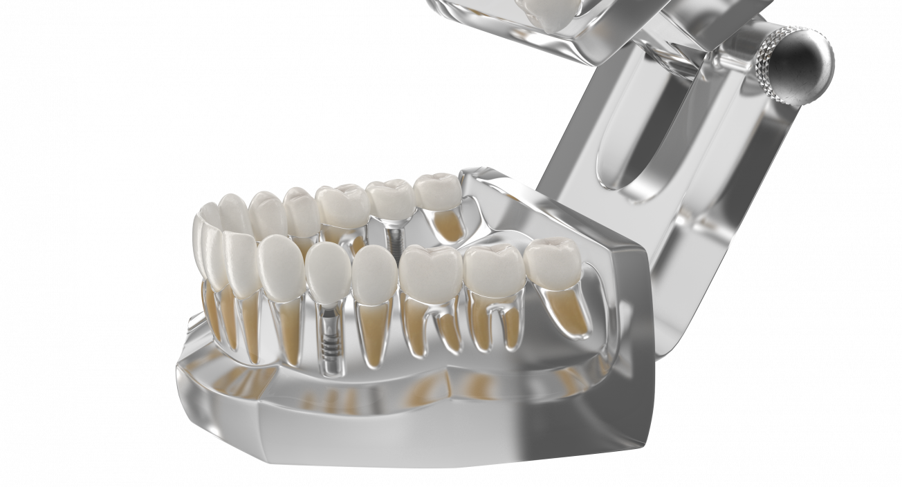 3D Transparent Dental Typodont With Dental Implants model