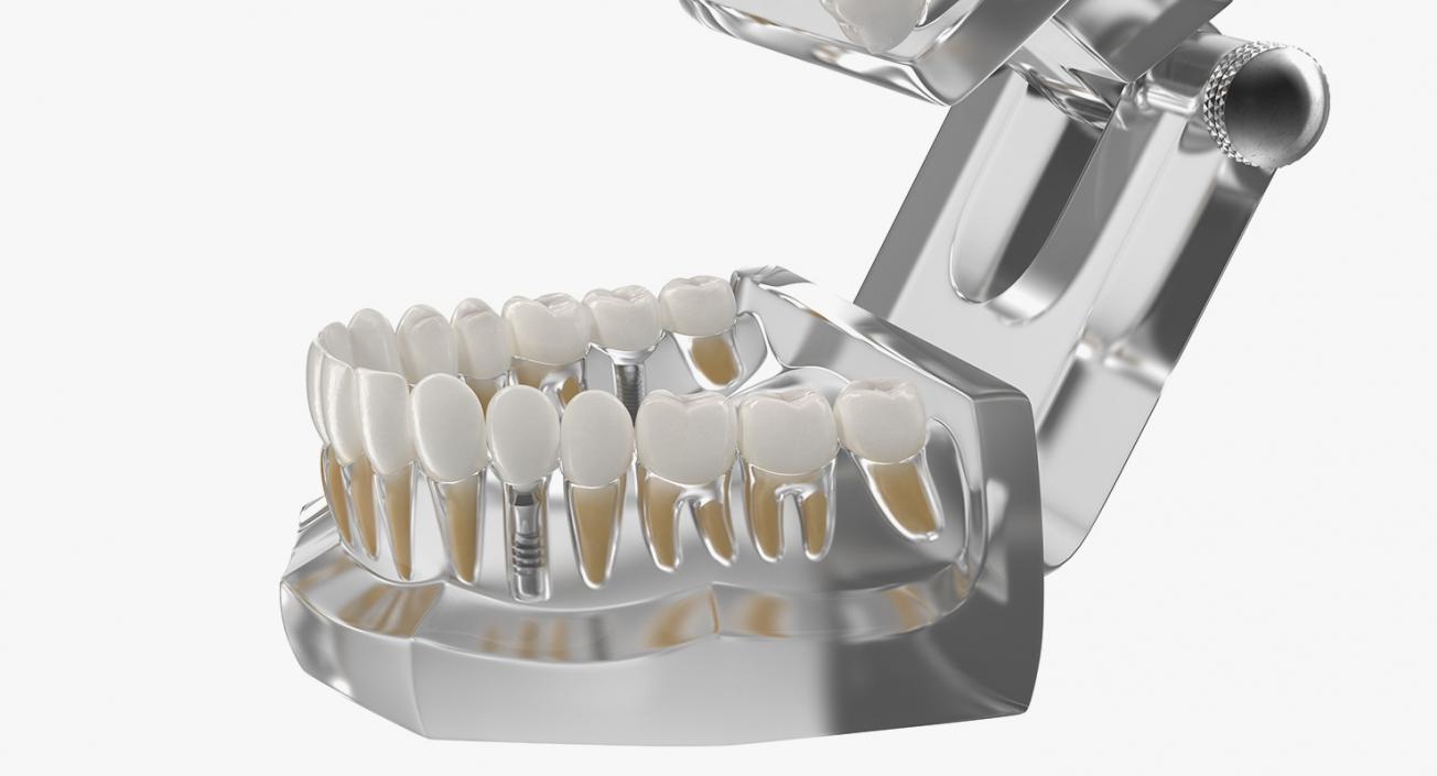 3D Transparent Dental Typodont With Dental Implants model