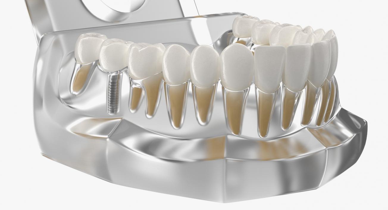 3D Transparent Dental Typodont With Dental Implants model