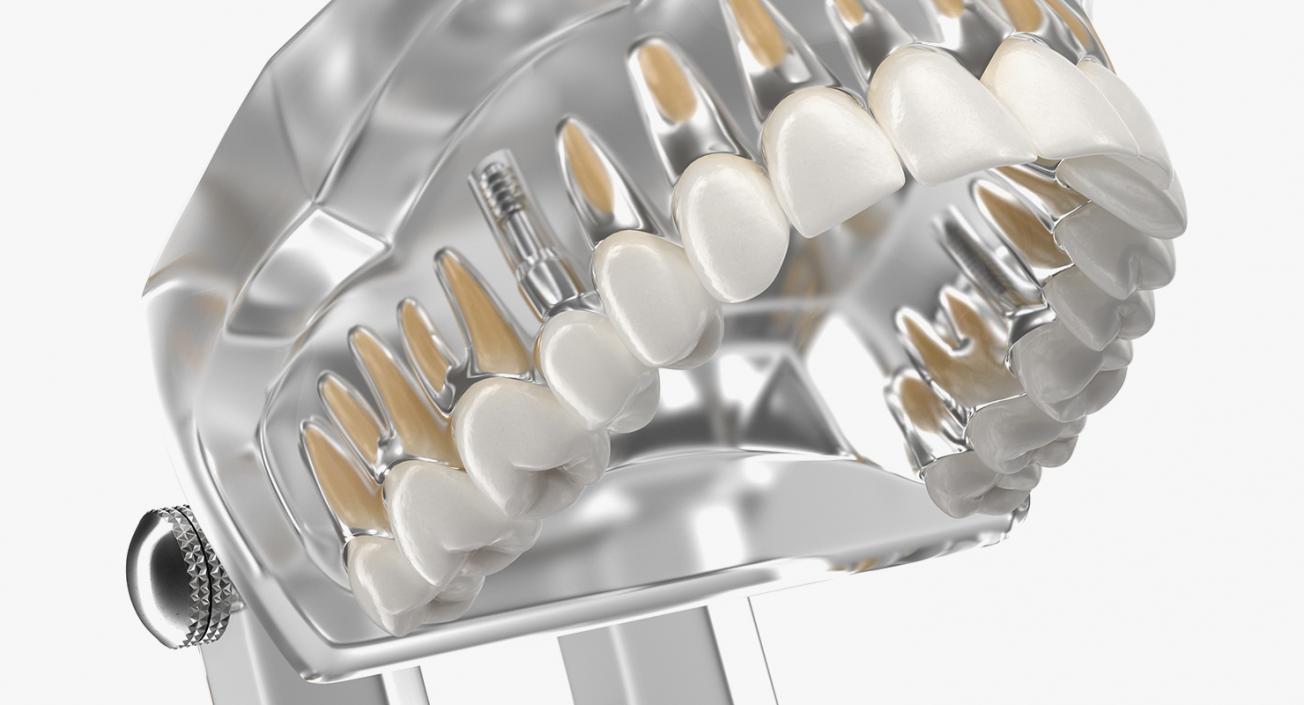 3D Transparent Dental Typodont With Dental Implants model