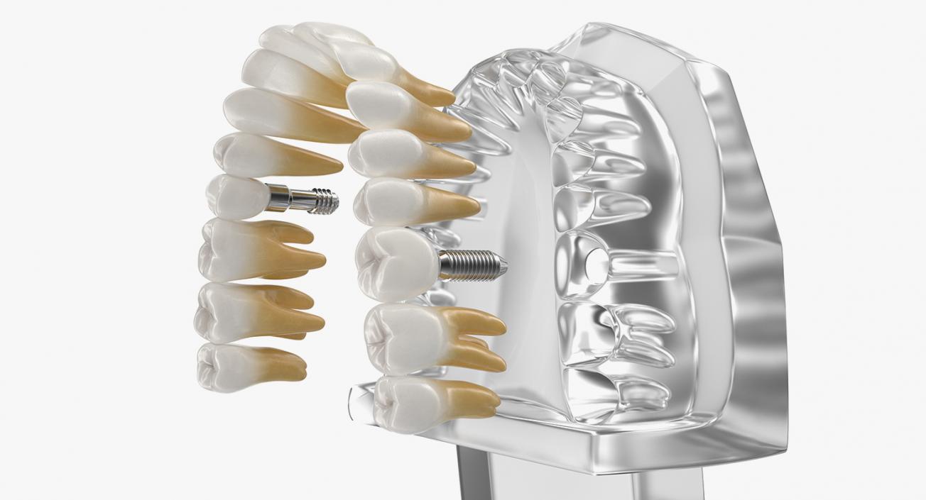 3D Transparent Dental Typodont With Dental Implants model