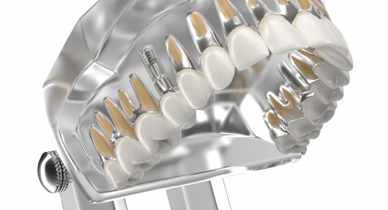 3D Transparent Dental Typodont With Dental Implants model