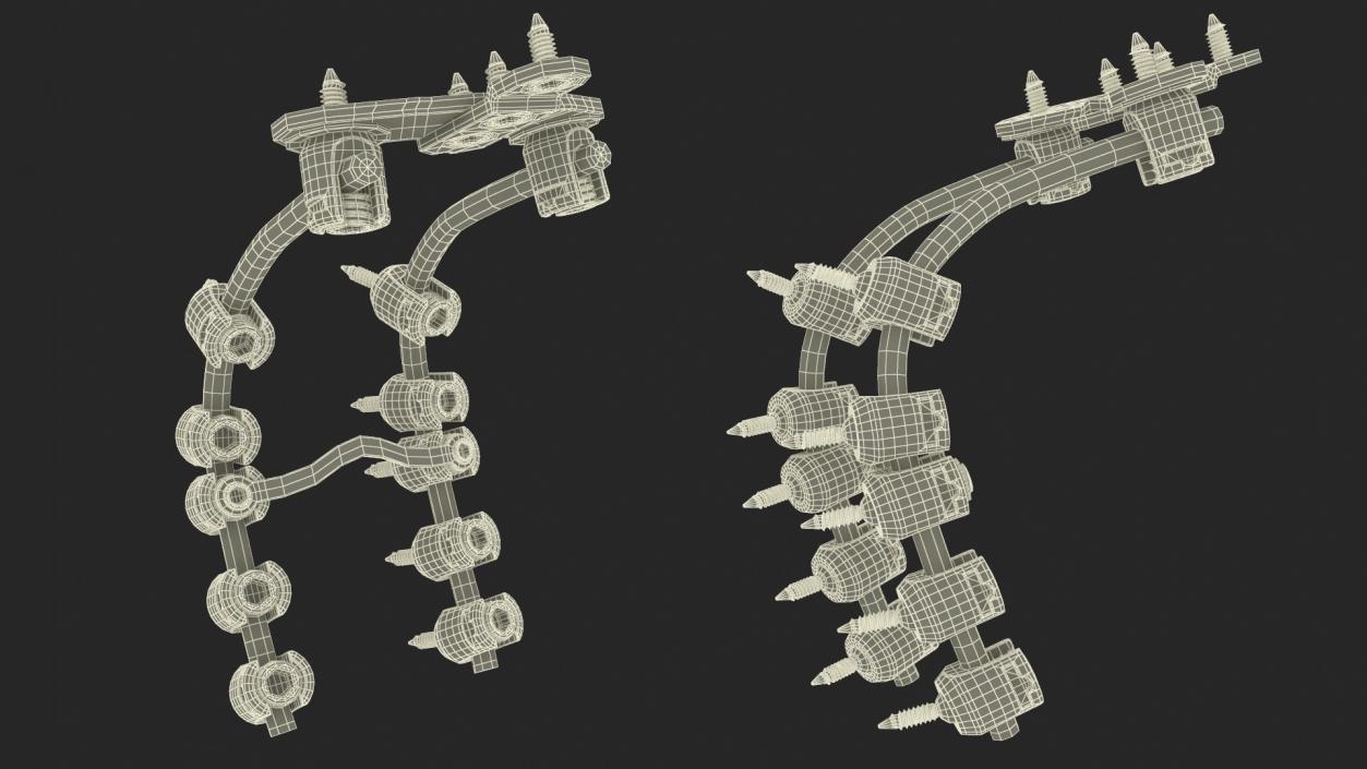 3D model Posterior Cervical Spine Fixation System