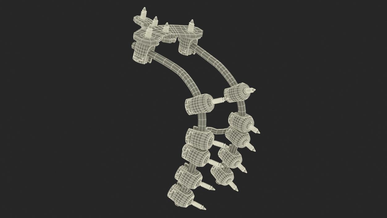 3D model Posterior Cervical Spine Fixation System