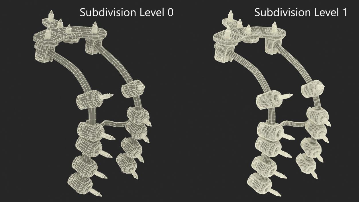 3D model Posterior Cervical Spine Fixation System