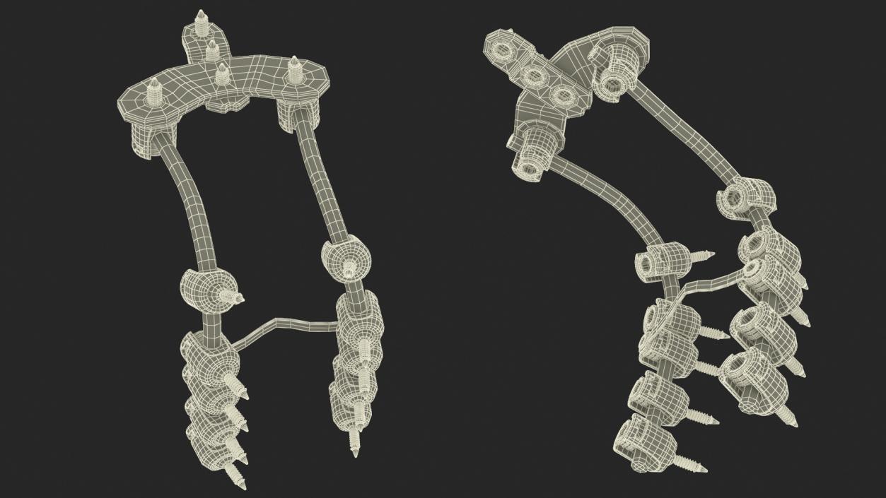 3D model Posterior Cervical Spine Fixation System