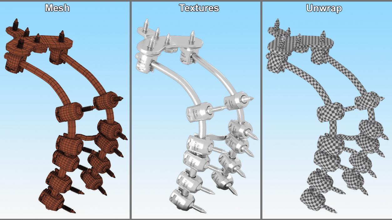 3D model Posterior Cervical Spine Fixation System