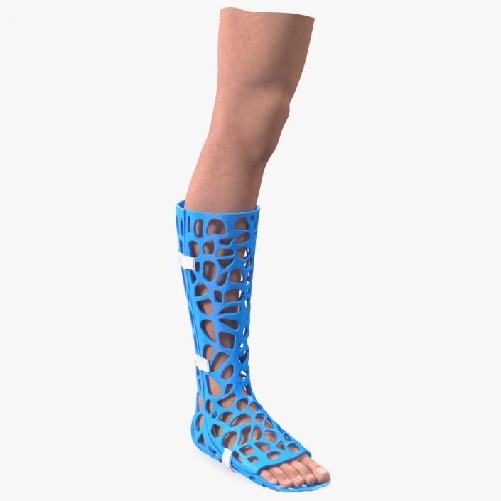 3D -Printed Orthopedic Cast On Leg