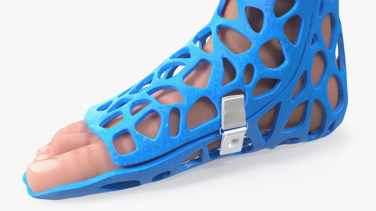 3D -Printed Orthopedic Cast On Leg