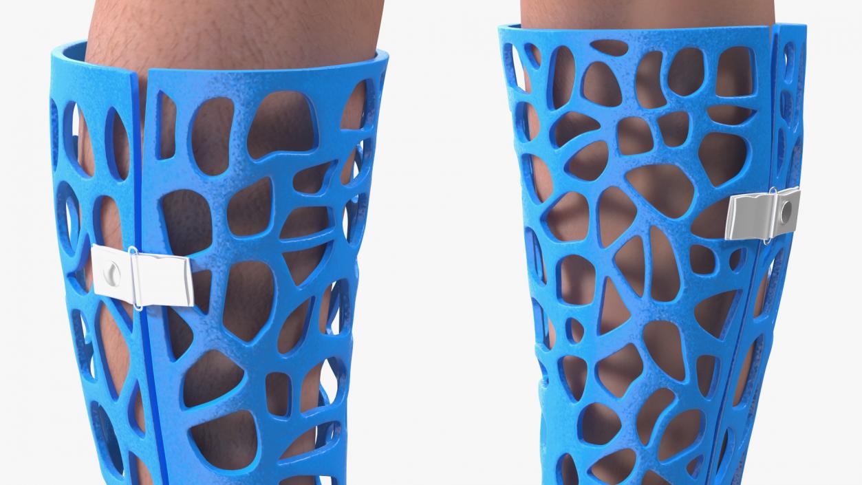 3D -Printed Orthopedic Cast On Leg