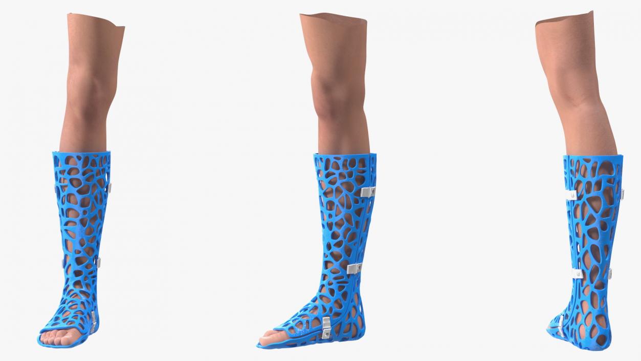 3D -Printed Orthopedic Cast On Leg