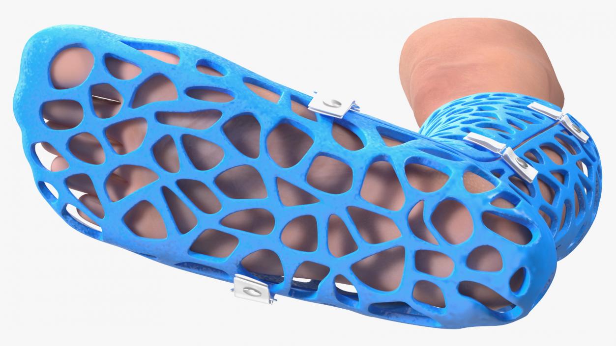 3D -Printed Orthopedic Cast On Leg