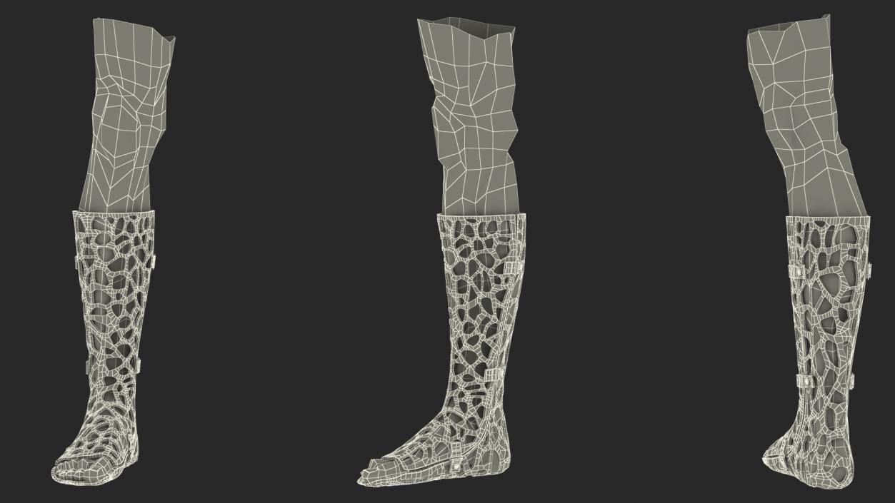 3D -Printed Orthopedic Cast On Leg