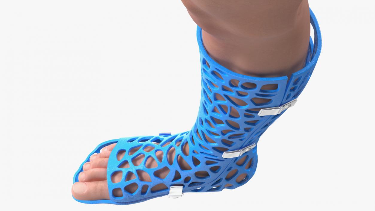 3D -Printed Orthopedic Cast On Leg