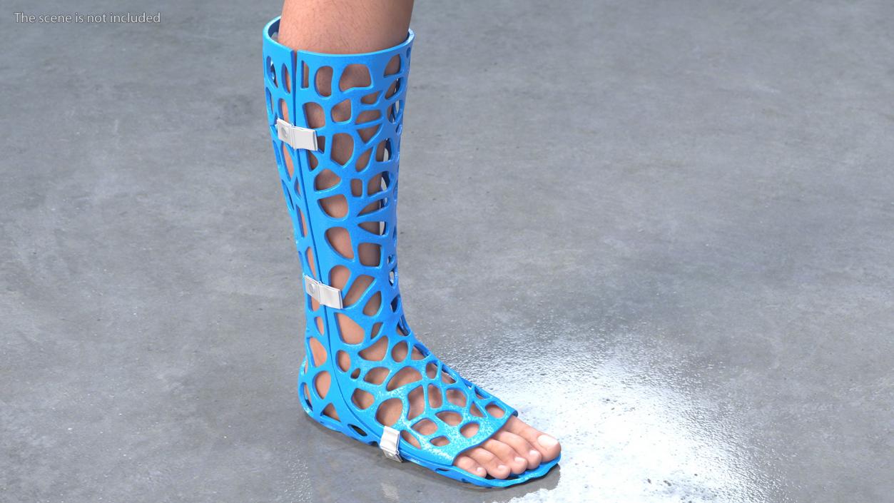 3D -Printed Orthopedic Cast On Leg