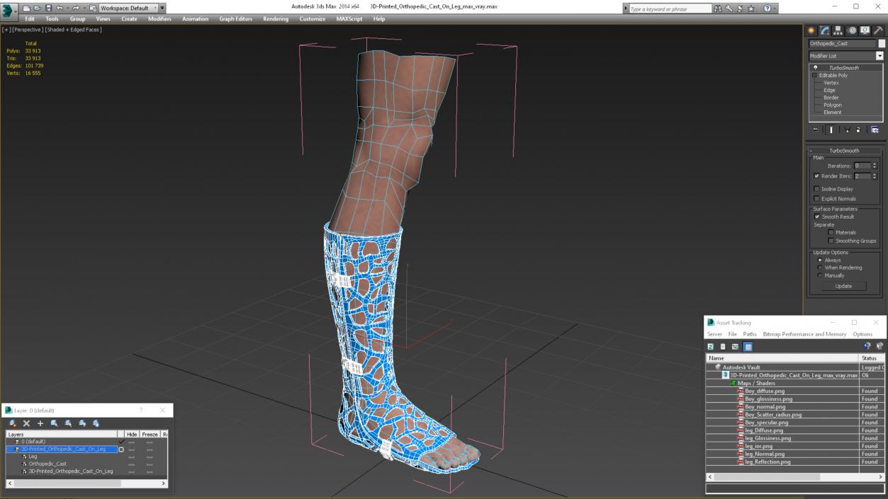 3D -Printed Orthopedic Cast On Leg