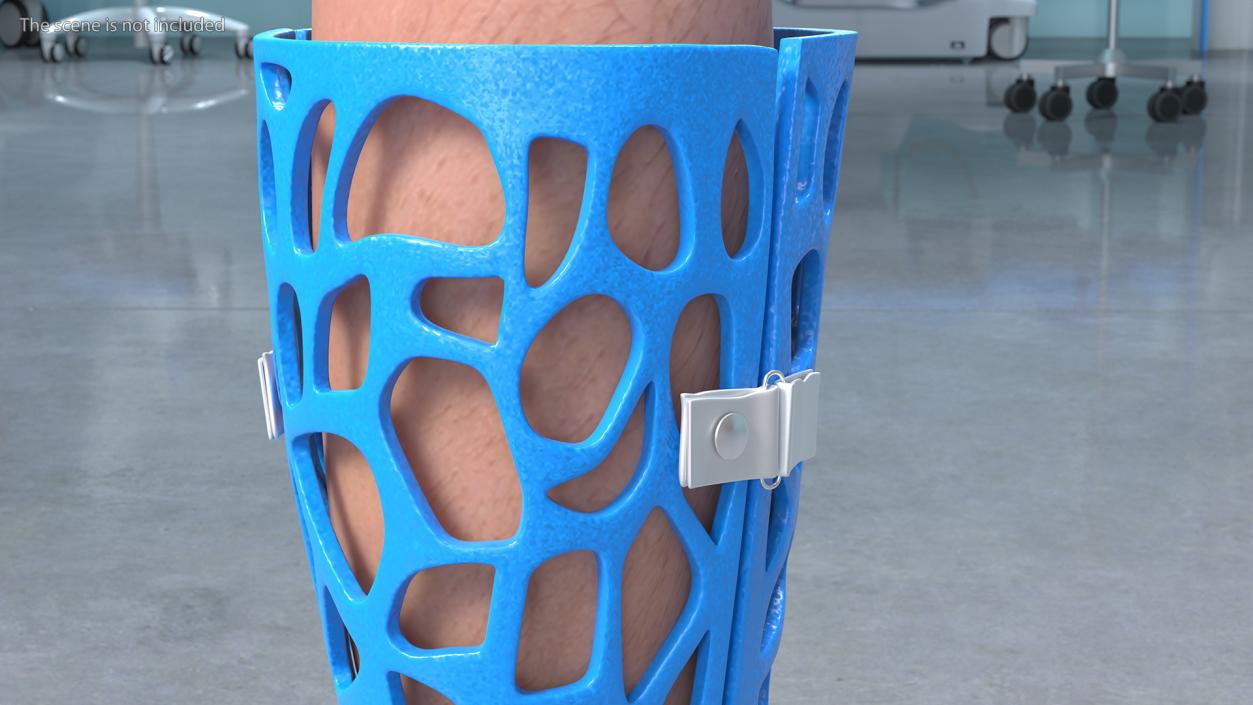 3D -Printed Orthopedic Cast On Leg