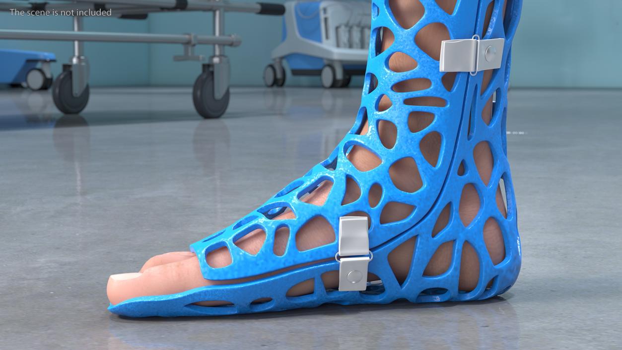 3D -Printed Orthopedic Cast On Leg