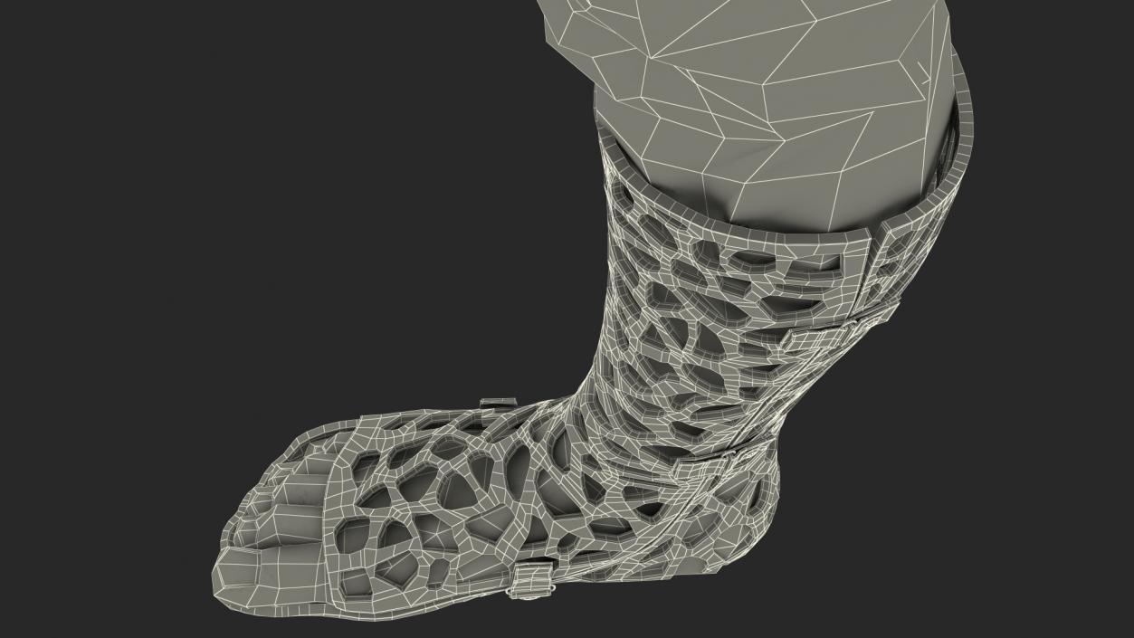 3D -Printed Orthopedic Cast On Leg