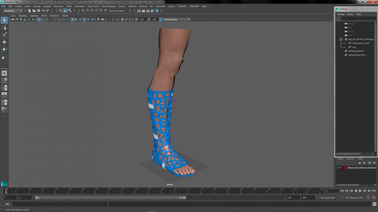 3D -Printed Orthopedic Cast On Leg