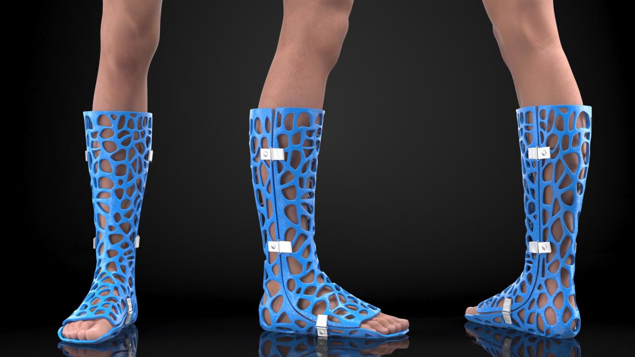 3D -Printed Orthopedic Cast On Leg