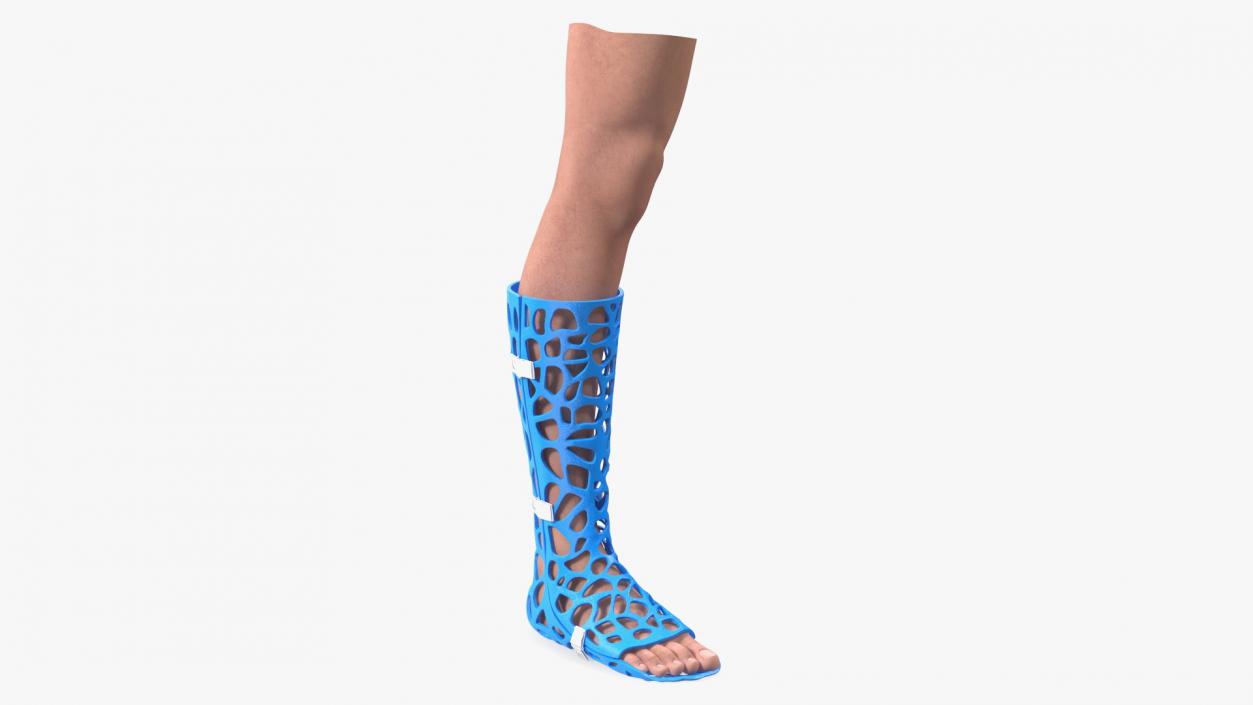 3D -Printed Orthopedic Cast On Leg