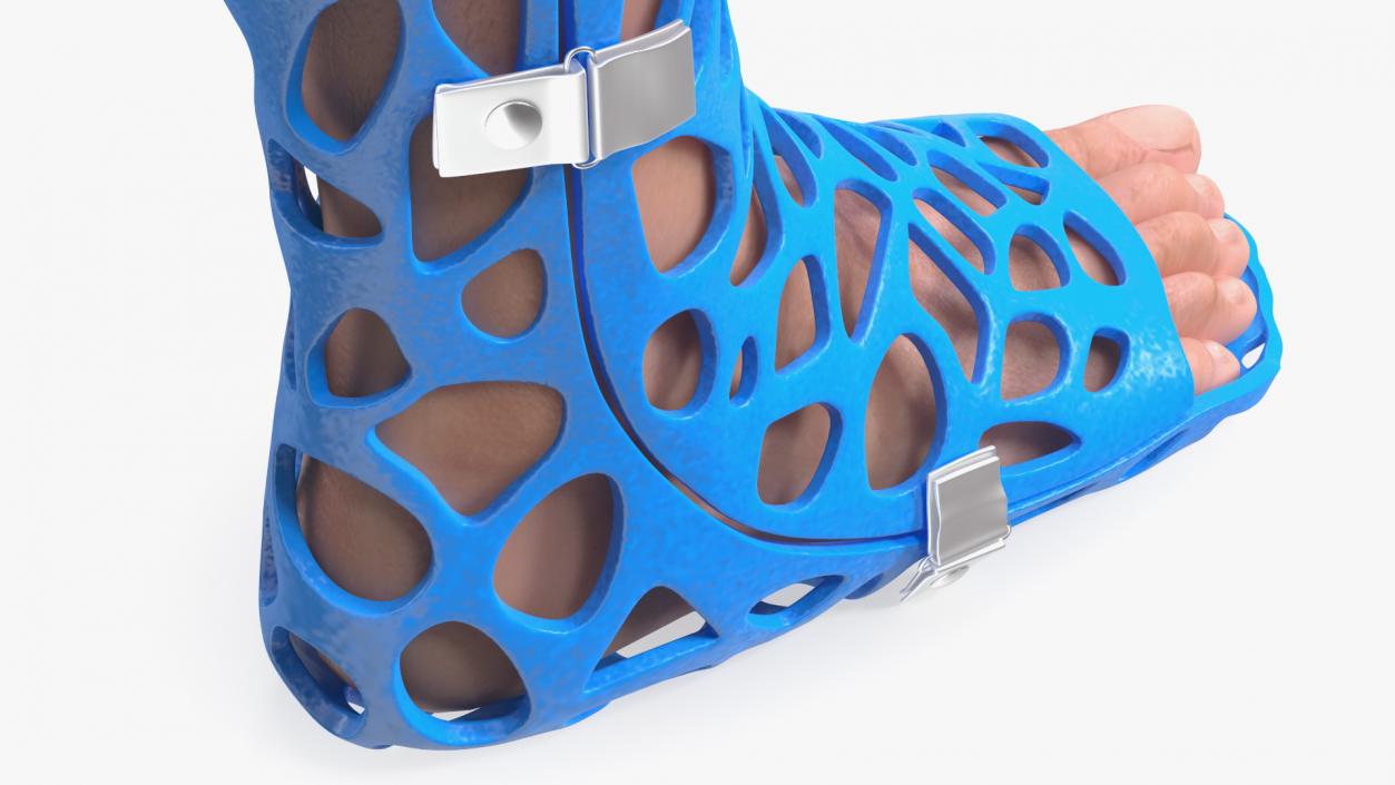 3D -Printed Orthopedic Cast On Leg