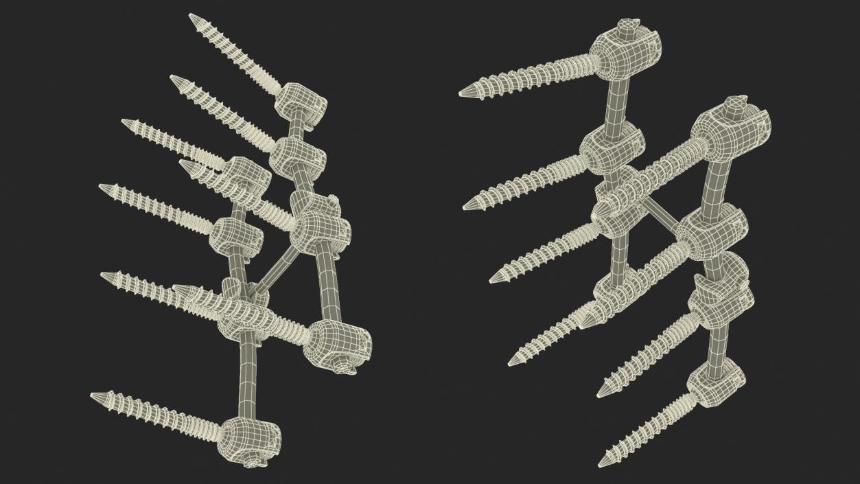 Lumbar Cervical Spine Fixation System 3D