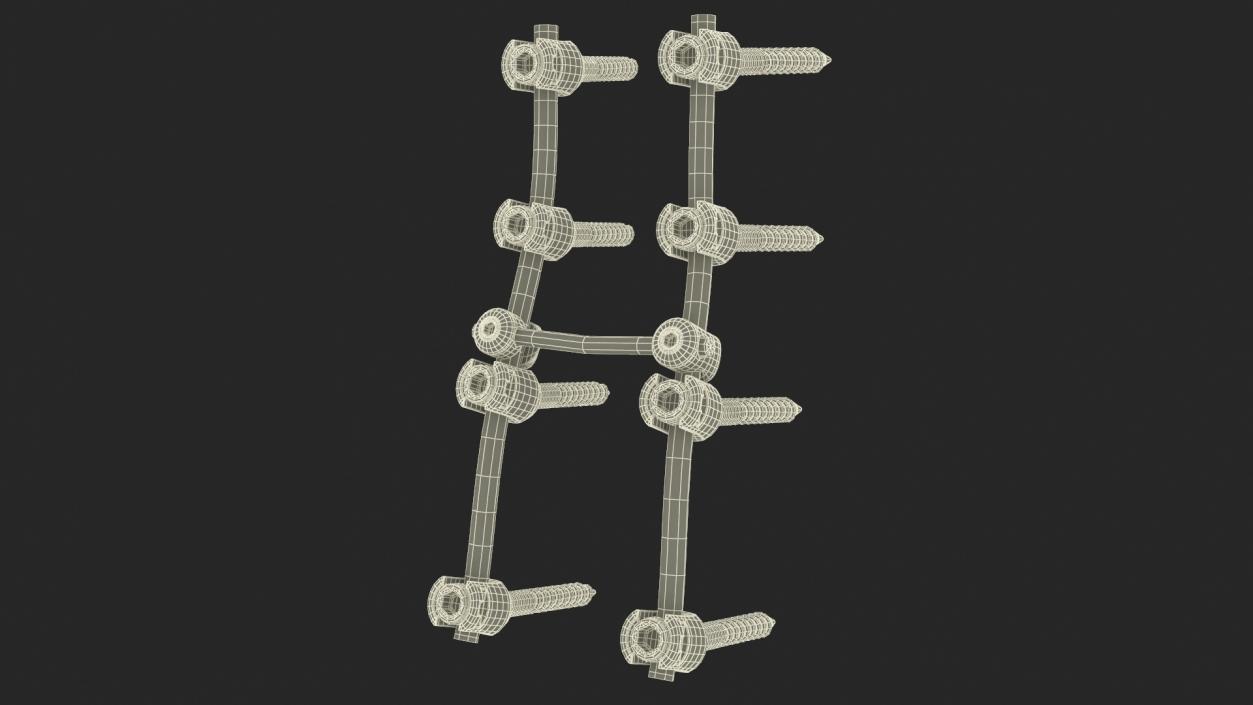 Lumbar Cervical Spine Fixation System 3D