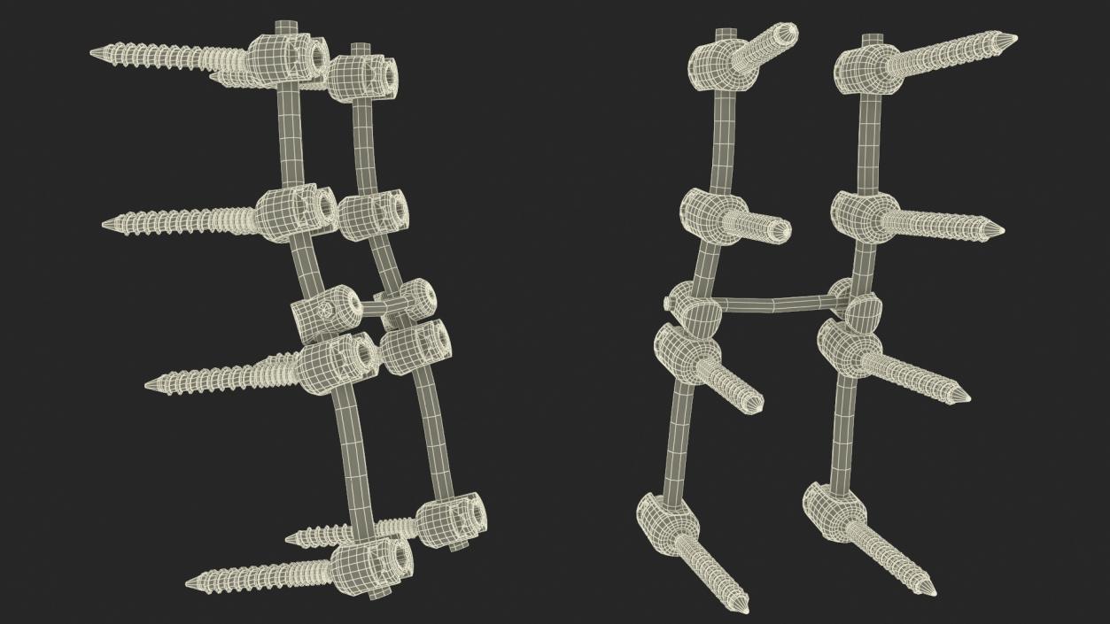 Lumbar Cervical Spine Fixation System 3D