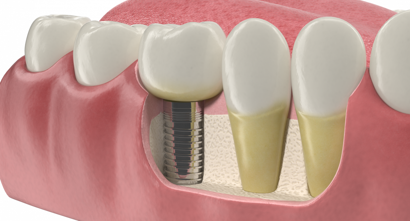 3D Teeth Tongue Medical Model With Dental Implant