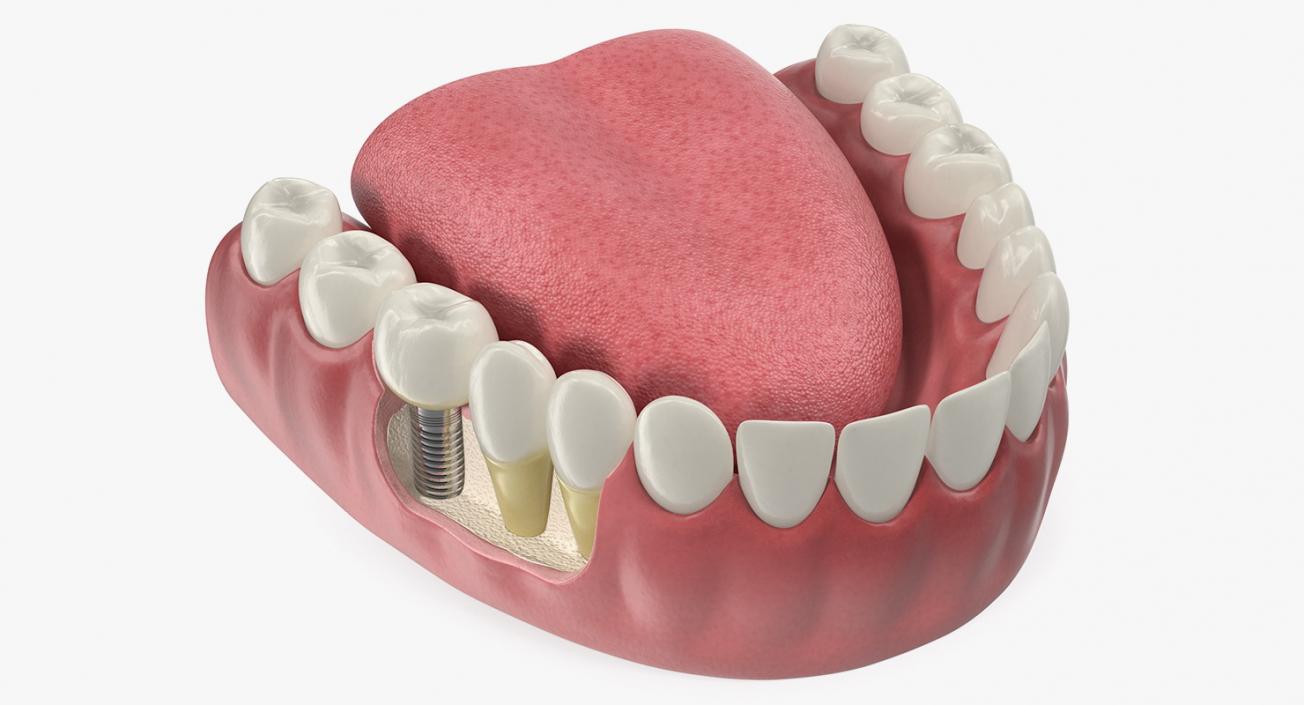 3D Teeth Tongue Medical Model With Dental Implant