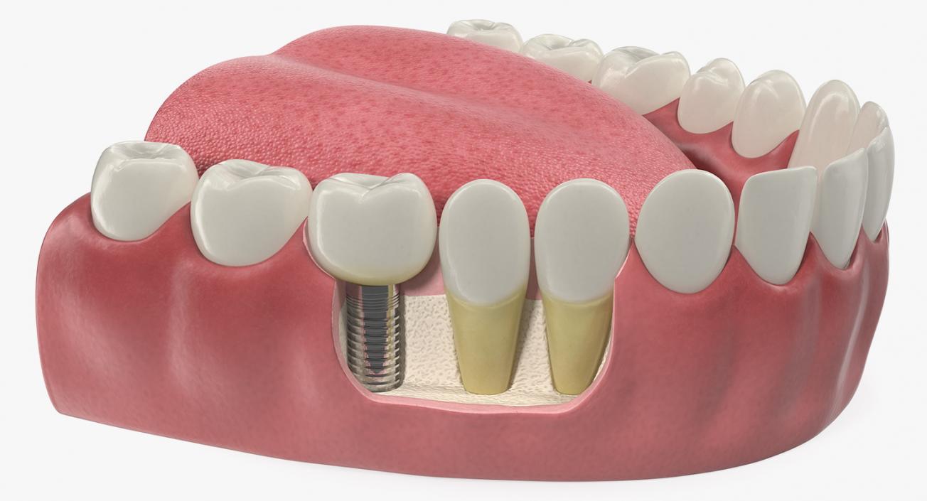 3D Teeth Tongue Medical Model With Dental Implant