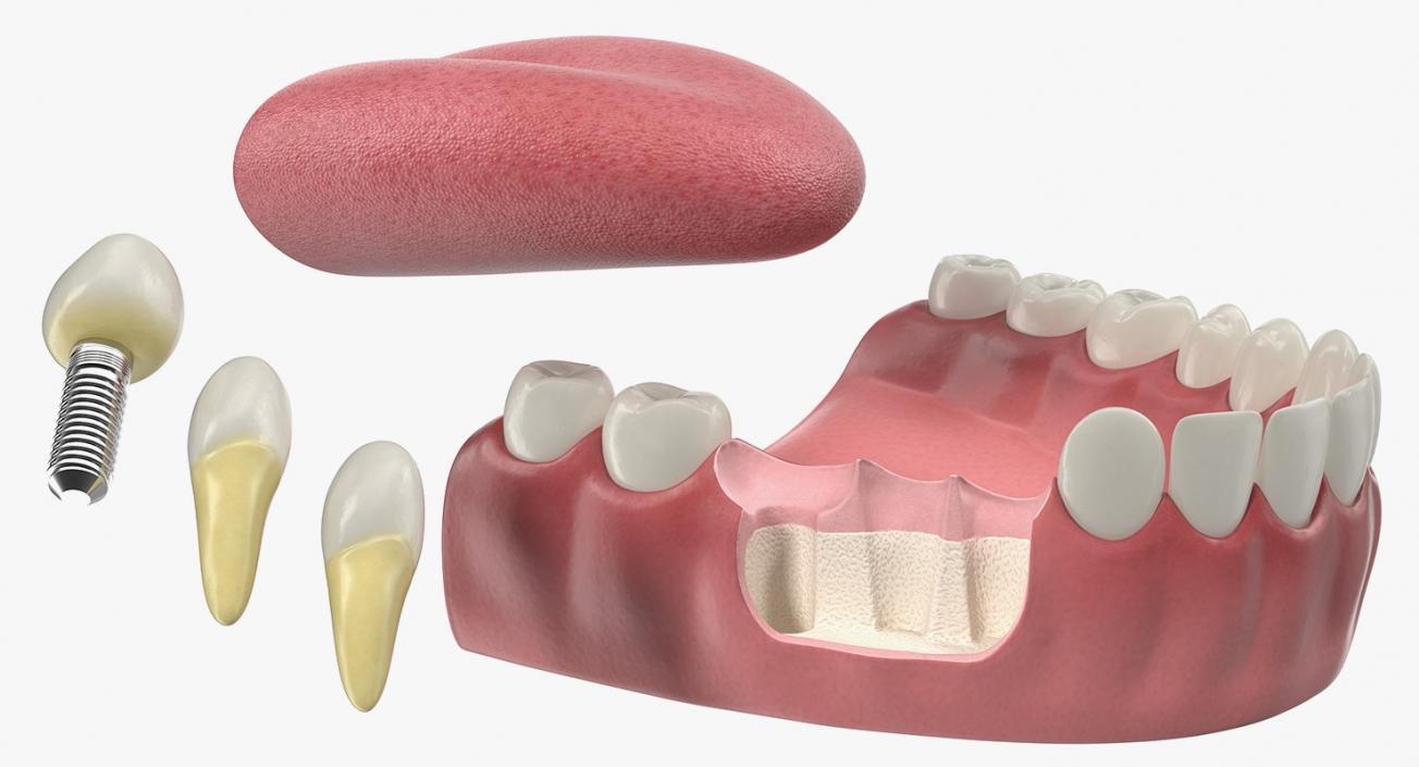 3D Teeth Tongue Medical Model With Dental Implant