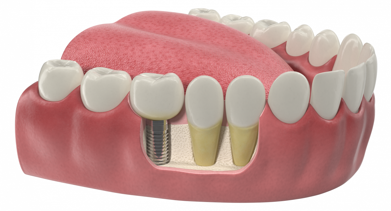 3D Teeth Tongue Medical Model With Dental Implant