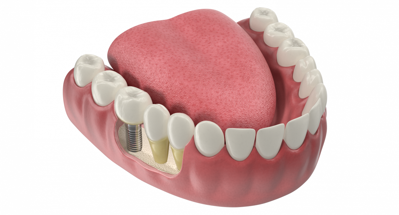 3D Teeth Tongue Medical Model With Dental Implant