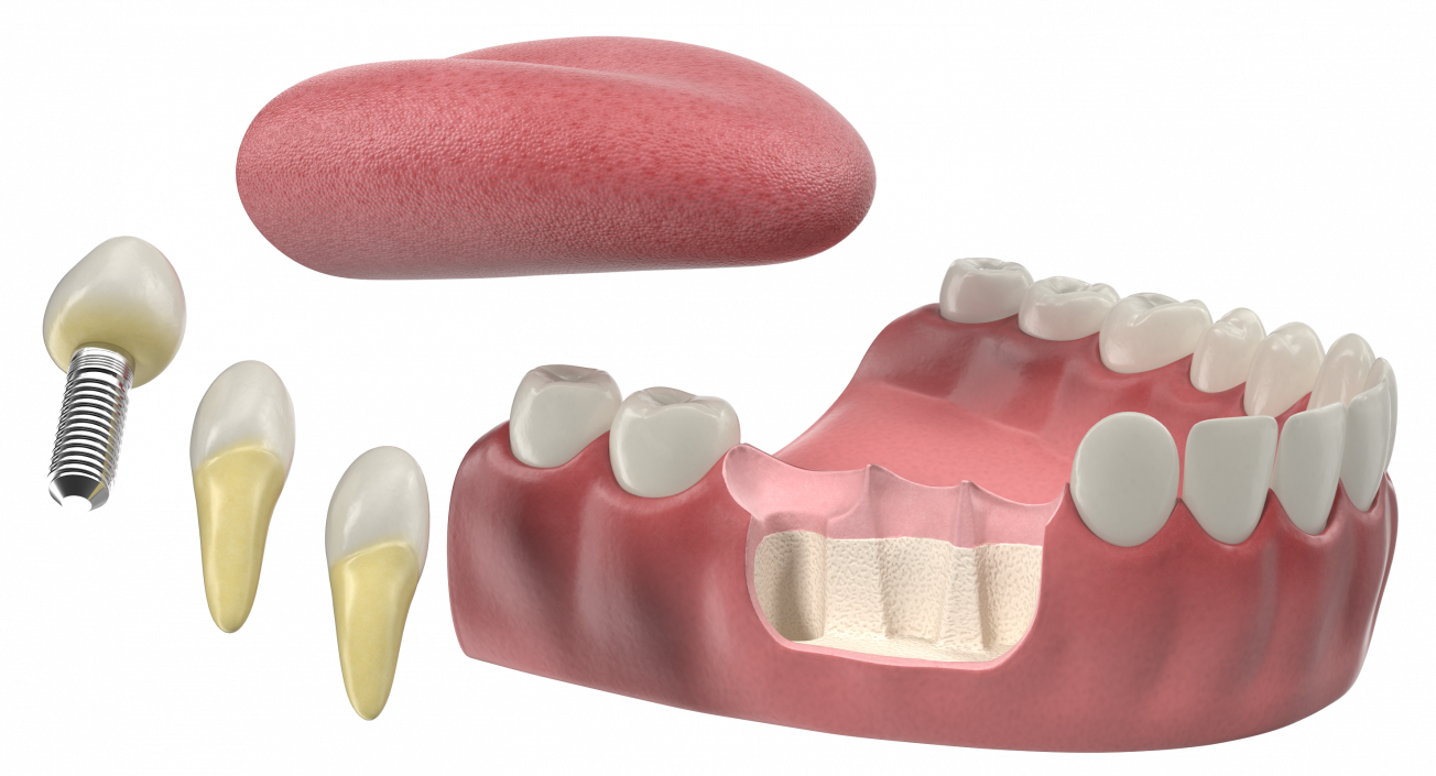 3D Teeth Tongue Medical Model With Dental Implant