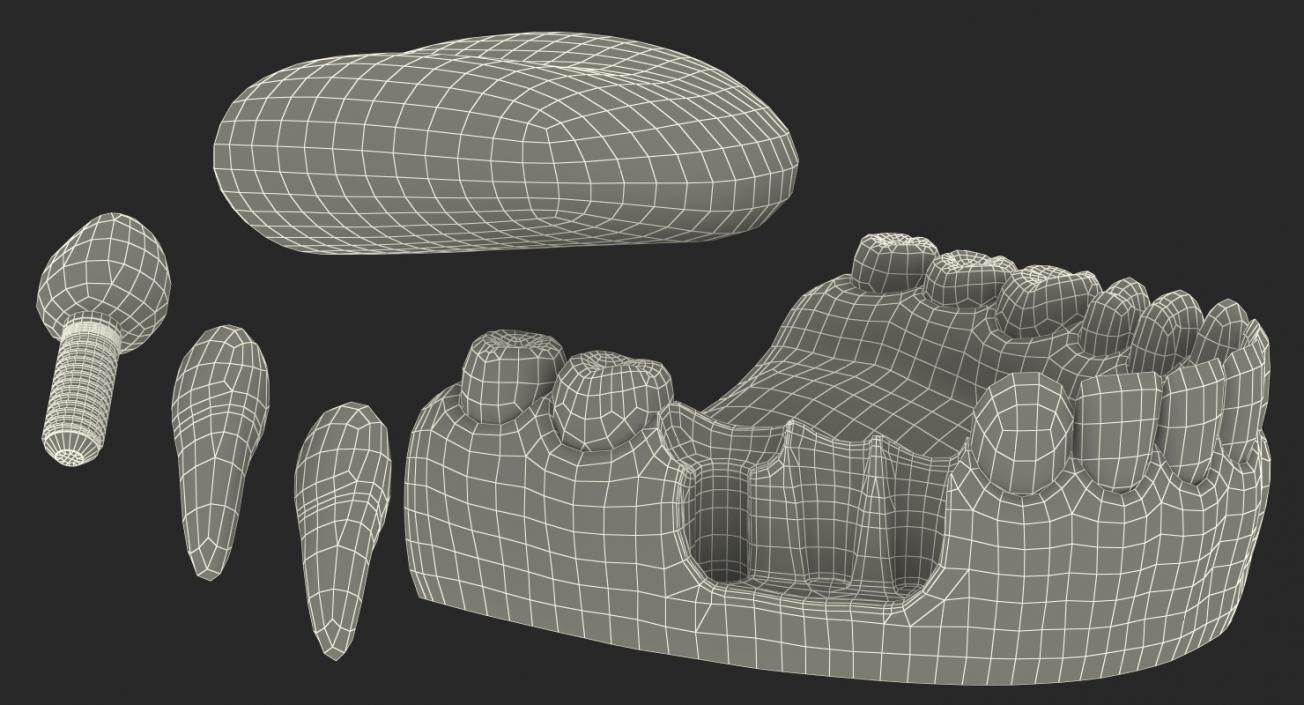 3D Teeth Tongue Medical Model With Dental Implant